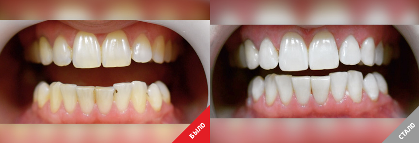 Отбеливание зубов: фото до и после