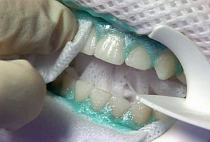 Нанесение геля при отбеливании зубов ЗУМ