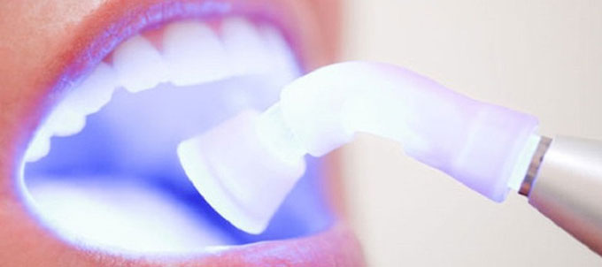Фото лазерного отбеливания зубов