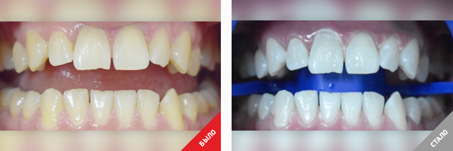 Фото отбеливания зубов до и после