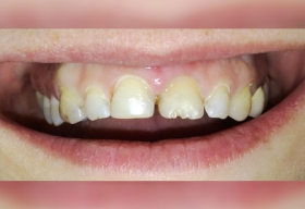 Восстановление дефектов фронтальных зубов винирами на основе оксида циркония