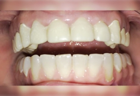 Комплексное восстановление эстетики и разрушенности верхних зубов