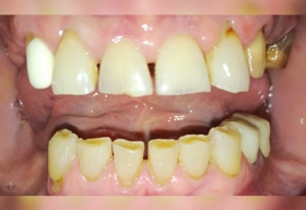 Комплексное восстановление функциональности и эстетики зубов