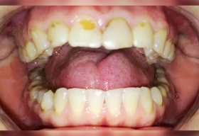 Косметический дефект и повышенная чувствительность передних верхних зубов.