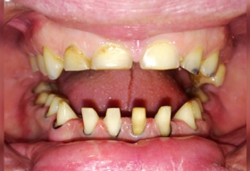 Комплексное восстановление эстетики и разрушенности зубов