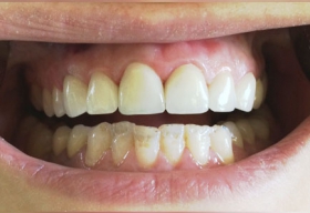 Пациентка довольна результатом и планирует виниры на фронтальные зубы нижней челюсти.