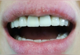 Изменен цвет и форма зубов, нижние зубы отбелены при помощи системы BEVERLY HILLS USA.