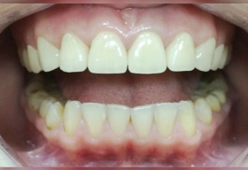 Восстановлена эстетика формы, изменен цвет зубов, нижние зубы отбелены системой «Beverly Hills USA».