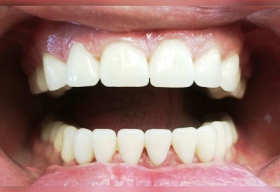 Благодаря безметалловой конструкции все зубы сохранены живыми (без удаления нерва).